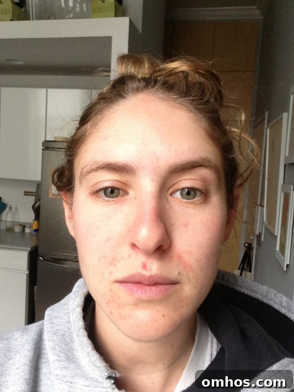Natural Perioral Dermatitis Remedies Dermatologists Don't Share 3 perioral dermatitis healing stages - picture of the author before treatment