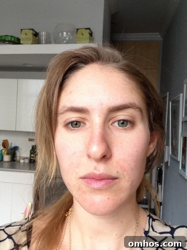 Natural Perioral Dermatitis Remedies Dermatologists Don't Share 4 perioral dermatitis healing stages - picture of the author after 2 weeks of treatment