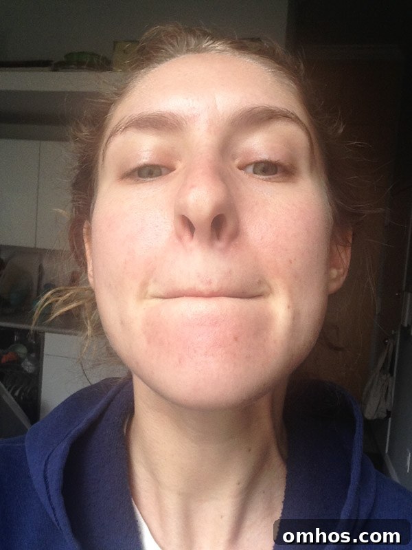 Natural Perioral Dermatitis Remedies Dermatologists Don't Share 5 perioral dermatitis healing stages - picture of the author after 4 weeks of natural treatment at home